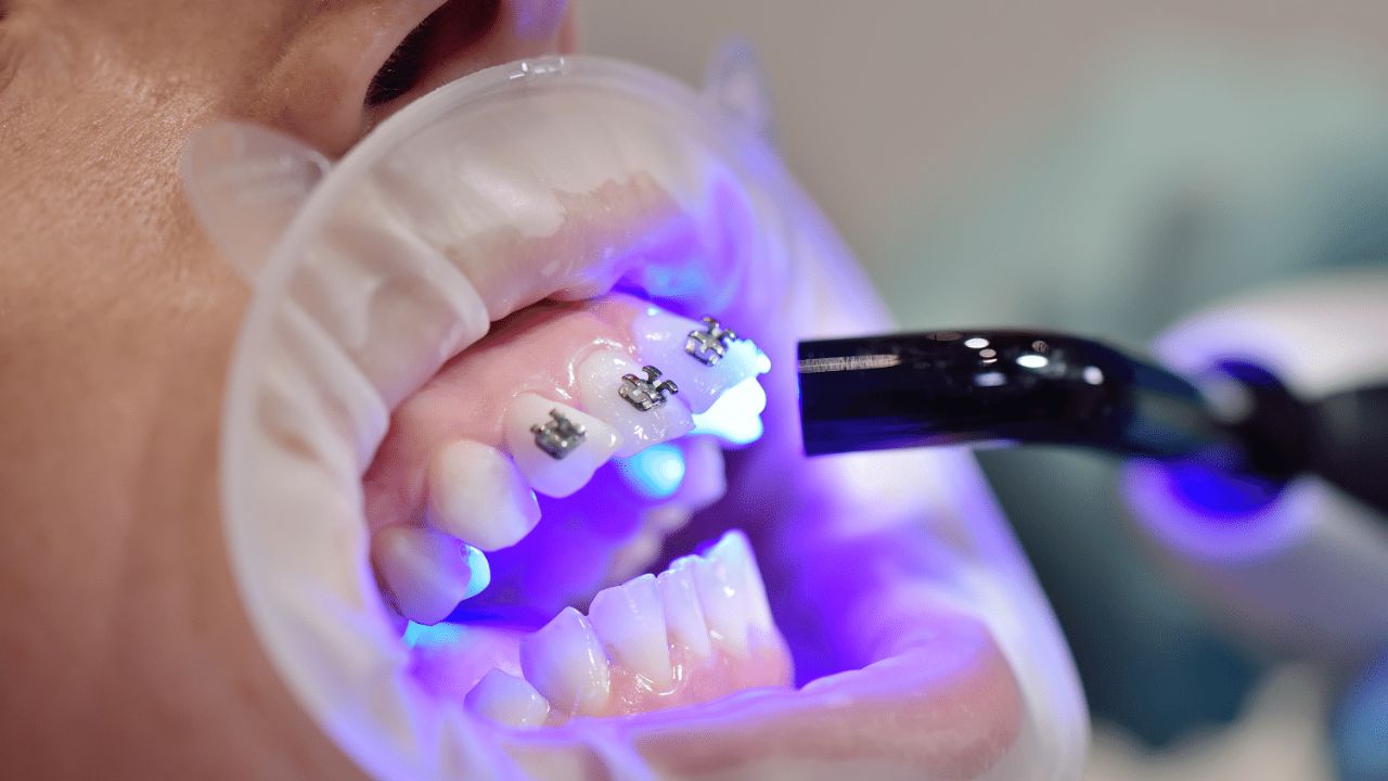 Common Dental Disease and Their Treatment Part 2